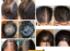 KIMERA HAIR GFP RNA EGZOSOMI  6-u-1 1x2ml– Revolucionarna terapija protiv gubitka kose