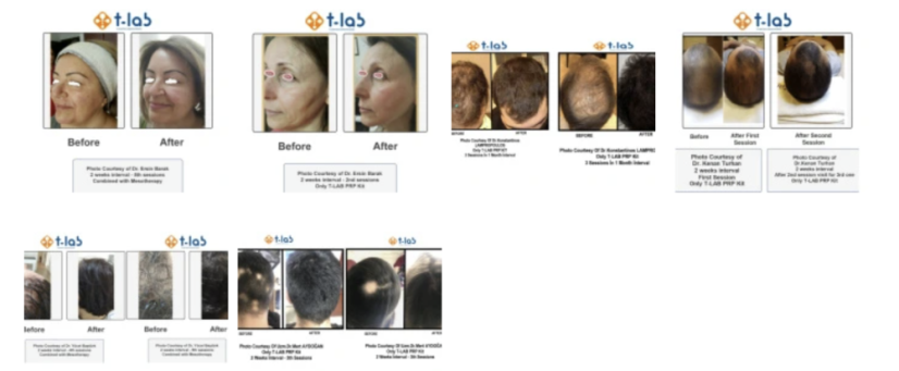 T-LAB NEXT PRP ŠPRICA 3-u-1-PRP epruveta koja se pretvara u PRP špricu