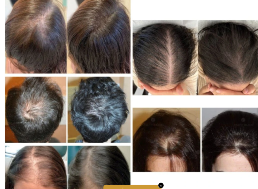 KIMERA HAIR GFP RNA EGZOSOMI  6-u-1 1x2ml– Revolucionarna terapija protiv gubitka kose