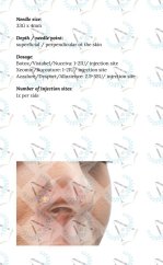 Botulinum Toxin In Aesthetic Medicine - Pocket Guide - Numerous "cheatsheets" and tips & tricks for quick orientation and safe BTX injections